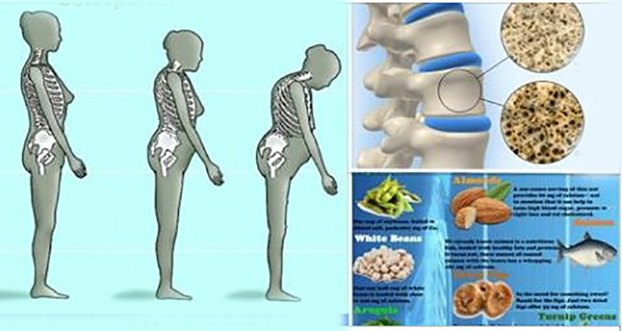 Пить ли кальций при переломах. Профилактика остеопороза. Остеопороз кальций. Кальций для костей позвоночника. Остеопороз позвоночника.