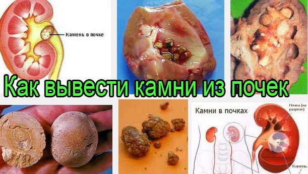 Песок и камни в почках: выход есть! - Советы для тебя